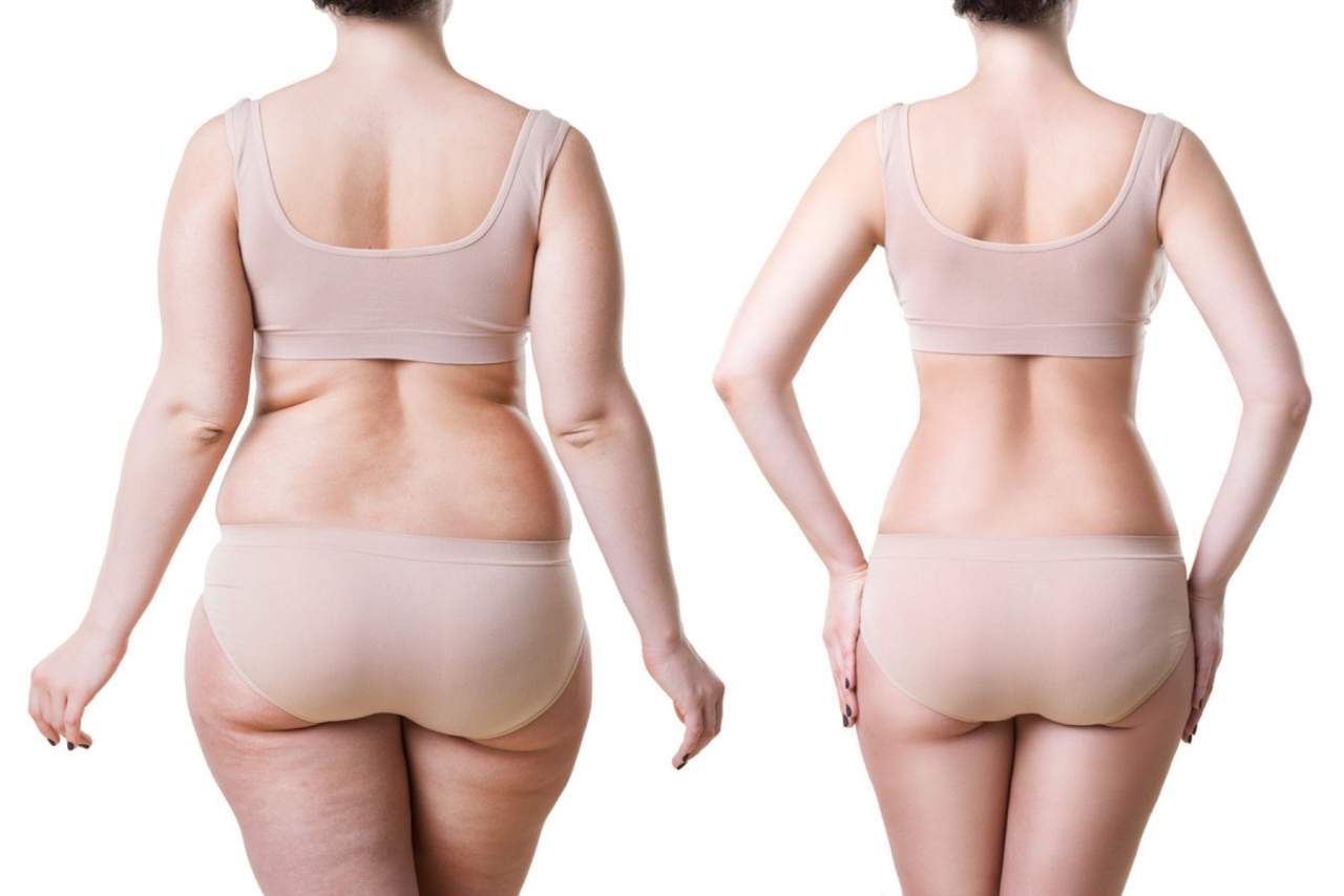 El tratamiento que permite eliminar grasa localizada en Barcelona por la Clínica Ciscar: Hidrolipoclasia 4D